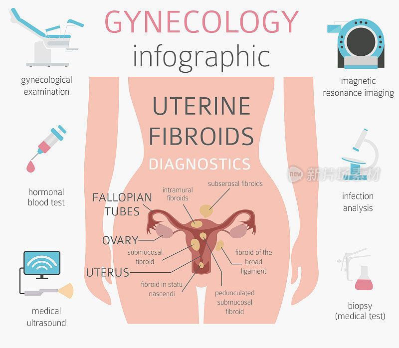 子宫平滑肌瘤。女性Ginecological medical disease信息图表